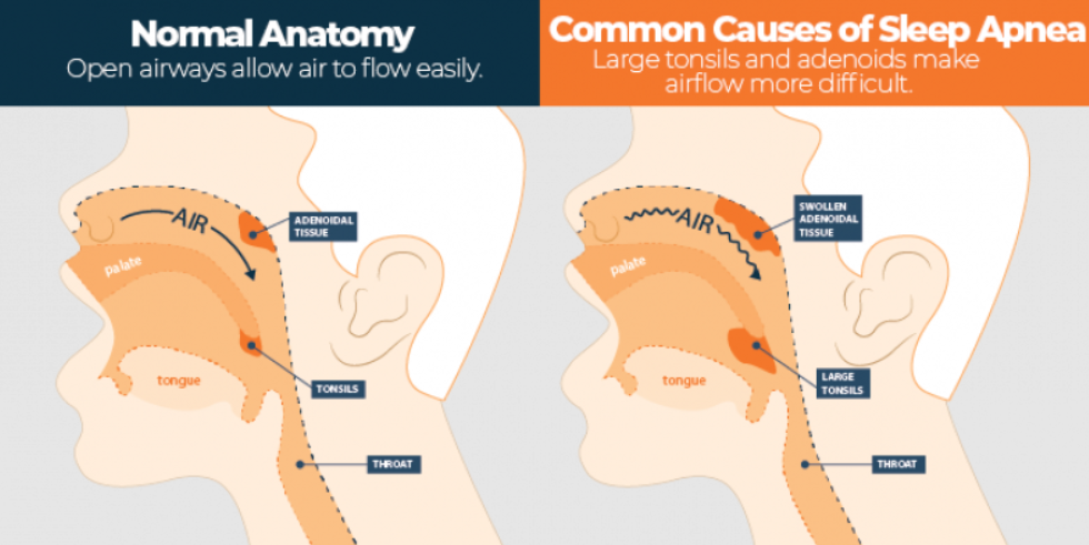 Pediatric-Sleep-Apnea thumbnail