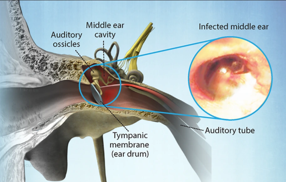 Understanding-Pediatric-Otitis-Media-Causes-Symptoms-Diagnosis-and-Treatment thumbnail